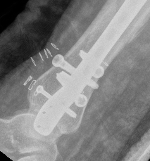 Posterior Malleolus 3